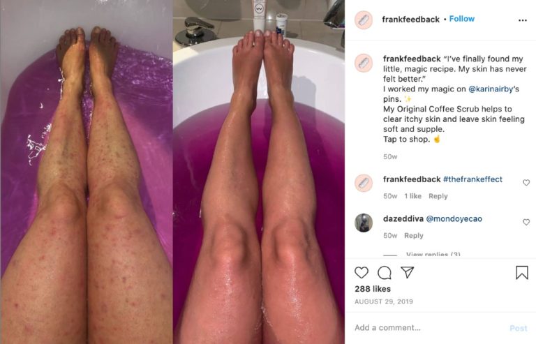 UGC from FrankFeedback showing a before and after image from a customer that was reshared by FrankBody on their FrankFeedback Instagram profile  
